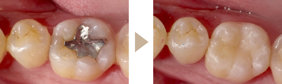 奥歯の銀歯を改善したい
