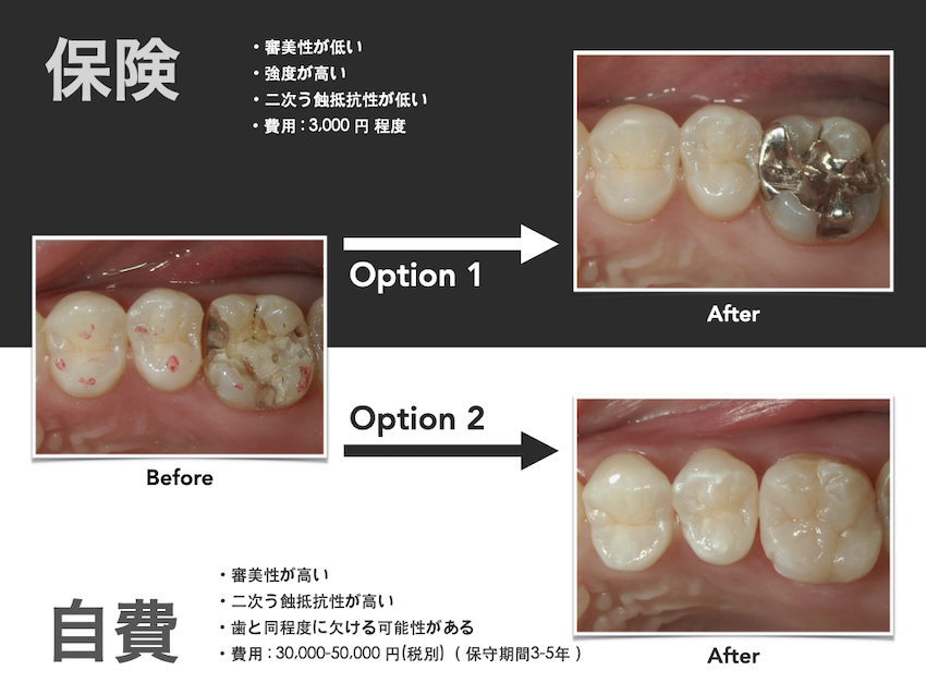 コンポジットレジン修復を受けられる方へ