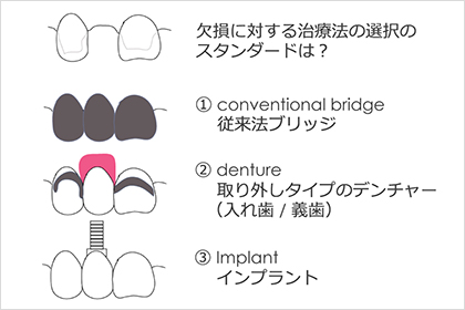 「削ってブリッジ」に抵抗がある方へ