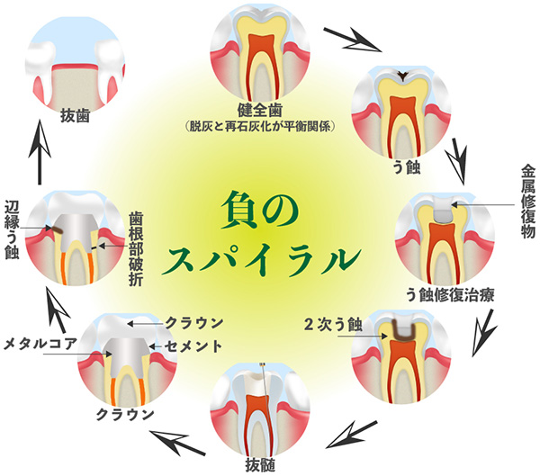 新時代のむし歯治療コンセプト