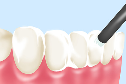 フッ素適用で再石灰化を促し削らないでいい歯をつくる