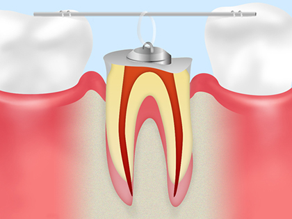 歯を残すための矯正治療